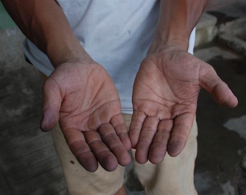 Bàn tay anh Nguyễn Văn Sơn đen xì vì rửa nước nhiễm sắt. (Ảnh: nongnghiep.vn)